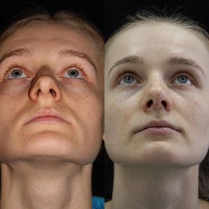 Открытая ринопластика изменила форму носа девушки и восстановила дыхание Фото 1