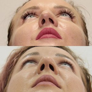 Как прошла сложная реконструкция перегородки носа Фото 1