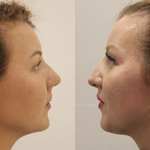 Как прошла сложная реконструкция перегородки носа Фото 3