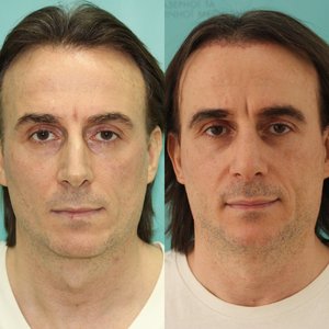 Мужская ринопластика - восстановление формы носа после травмы Фото 1