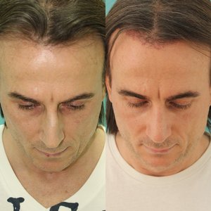 Мужская ринопластика - восстановление формы носа после травмы Фото 3