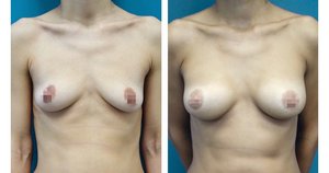 Увеличение груди в клинике Nove Tilo Фото 2