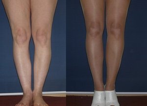 Новая форма ног после пластики голени Фото 2
