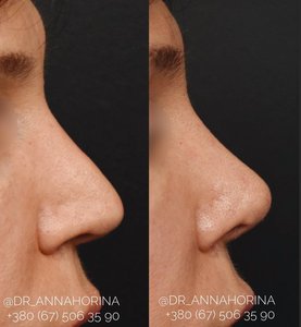 Третичная ринопластика Фото 2