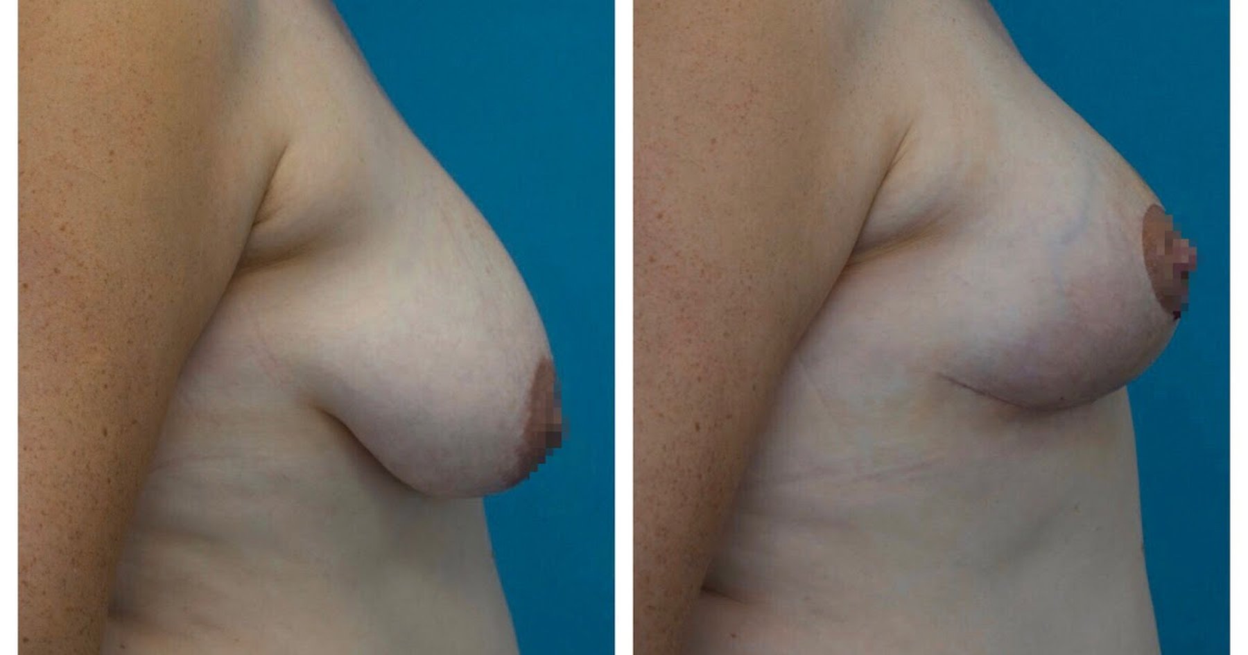 тубулярная форма груди у женщин фото 111