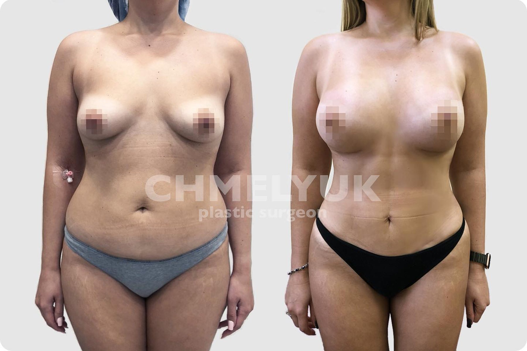 липосакции груди у женщин фото 29