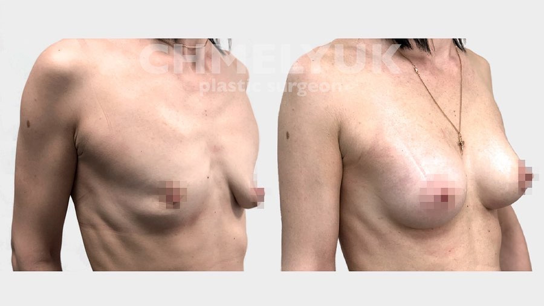 отзывы женщин о подтяжке груди фото 85